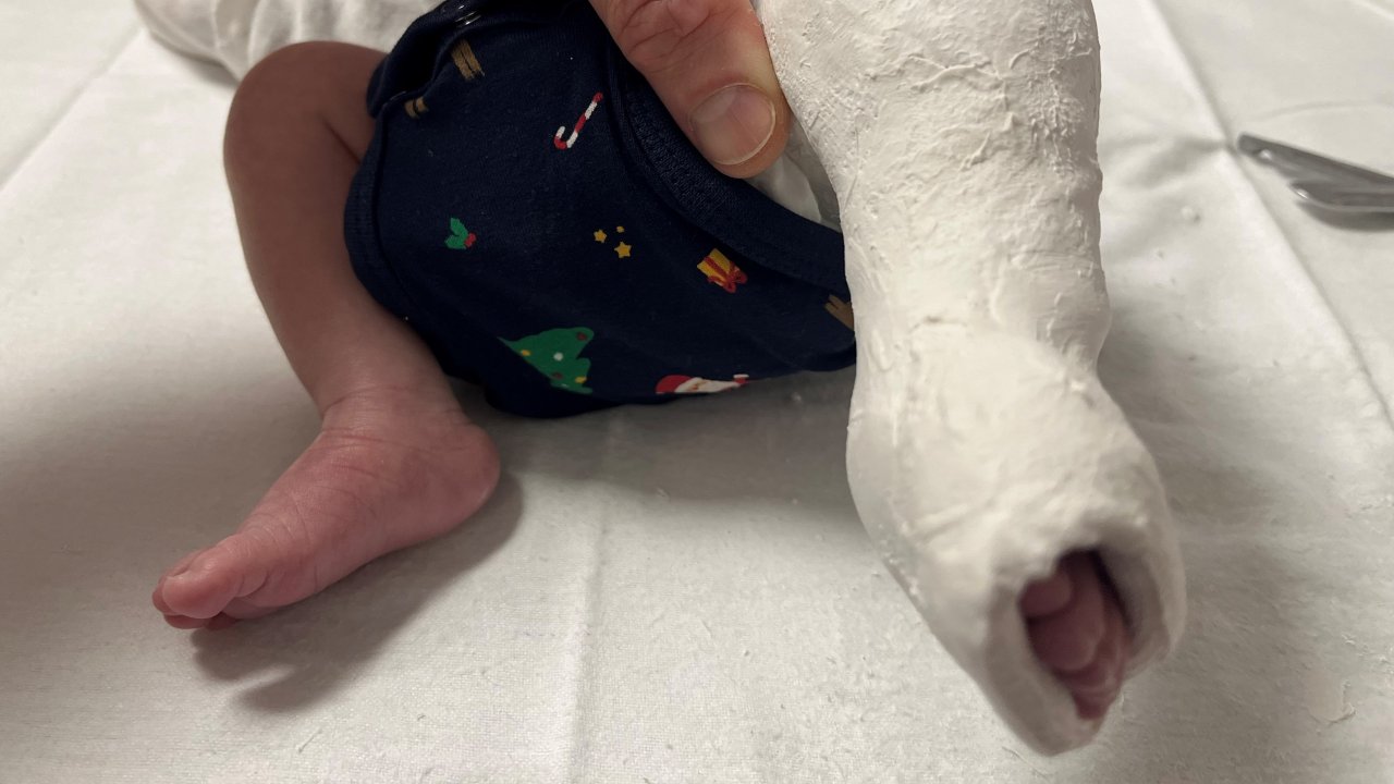 Ein bis zwei von 1.000 Säuglingen sind betroffen. Die Rede ist vom Klumpfuß. Dank moderner Therapiemethoden können Kinder mit einem Klumpfuß heute in den meisten Fällen erfolgreich behandelt werden. von privat
